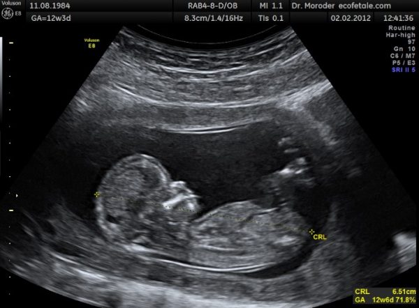 Ultrasounds in pregnancy