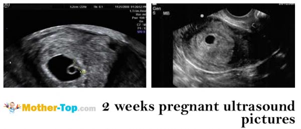 2 weeks pregnant ultrasound pictures