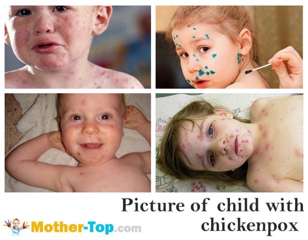 picture of child with chickenpox