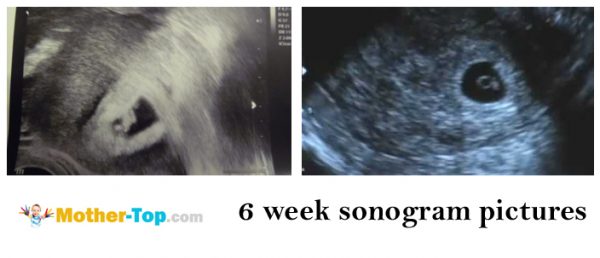 6 week sonogram pictures