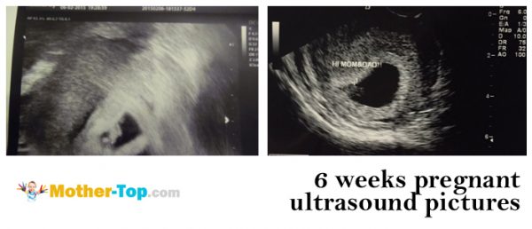 6 weeks pregnant ultrasound pictures