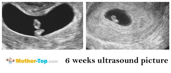 6 weeks ultrasound picture