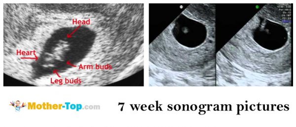 7 week sonogram pictures