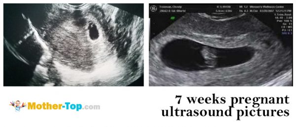 7 weeks pregnant ultrasound pictures