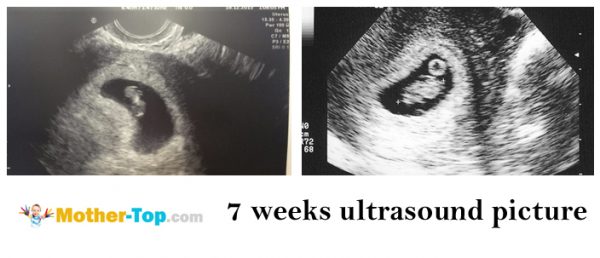 7 weeks ultrasound picture