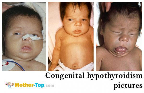congenital hypothyroidism pictures