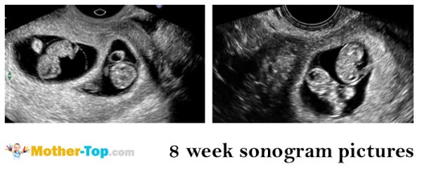 8 week sonogram pictures