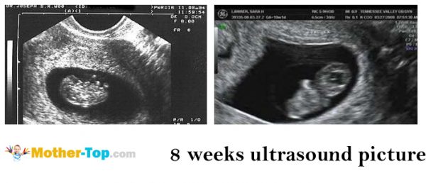 8 weeks ultrasound picture