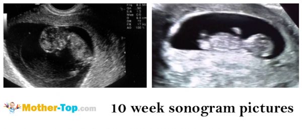 10 week sonogram pictures