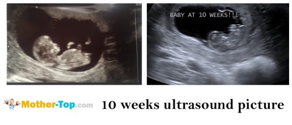 10 weeks pregnant ultrasound pictures