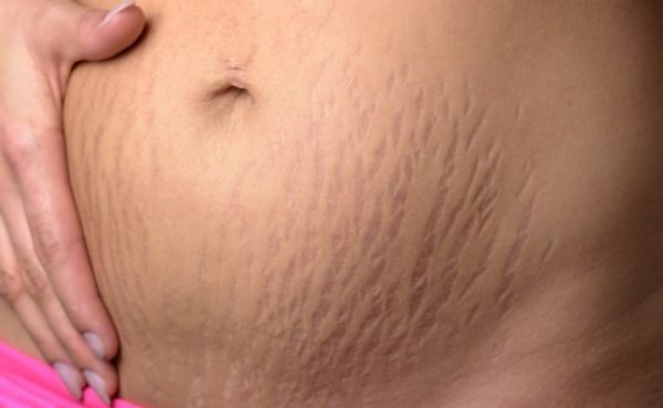 Can you get rid of pregnancy stretch marks