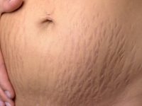 Can you get rid of pregnancy stretch marks