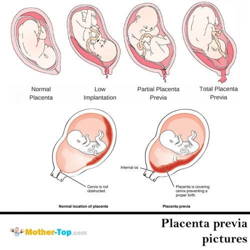 placenta previa pictures