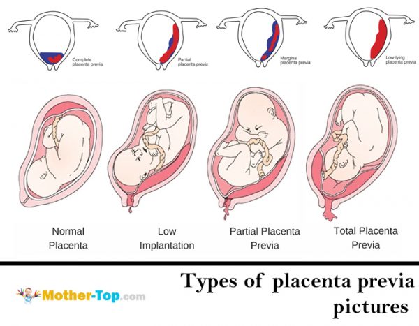 types of placenta previa pictures 