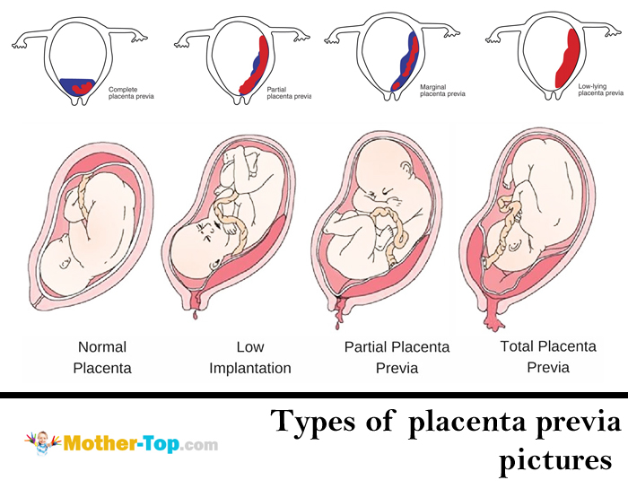 What is placenta previa? Causes, signs, childbirth ...