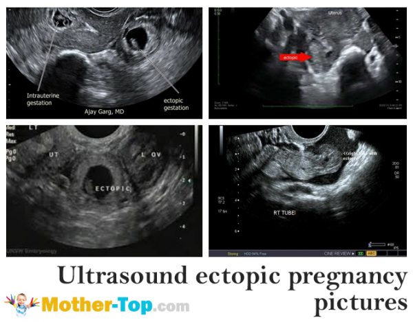 ultrasound ectopic pregnancy pictures