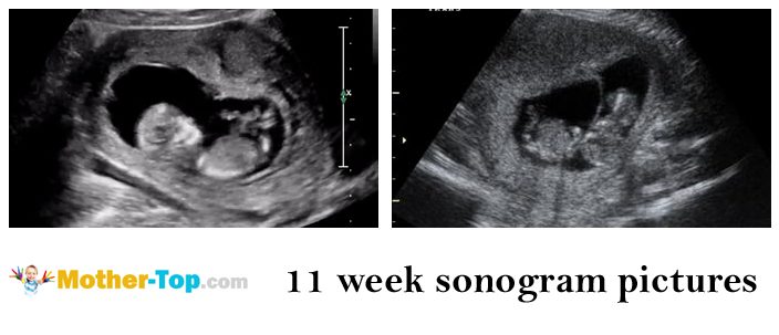 11 weeks pregnant — fetal development and mother's health ...