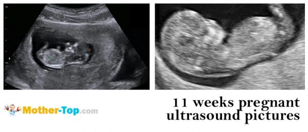 11 weeks pregnant ultrasound pictures