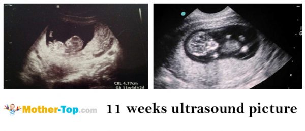 11 weeks ultrasound picture