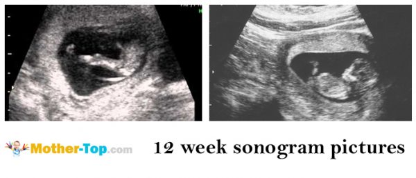 12 week sonogram pictures