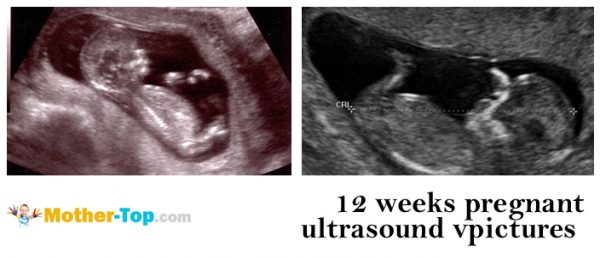 12 weeks pregnant ultrasound pictures