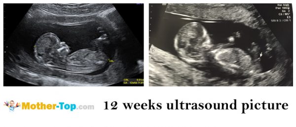 12 weeks ultrasound picture