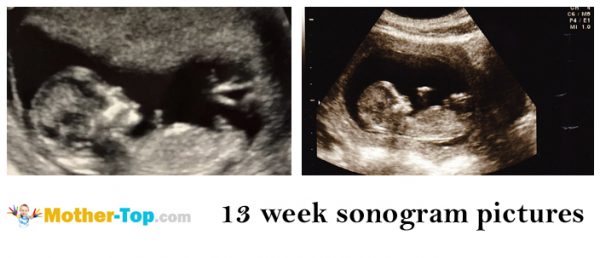 13 week sonogram pictures