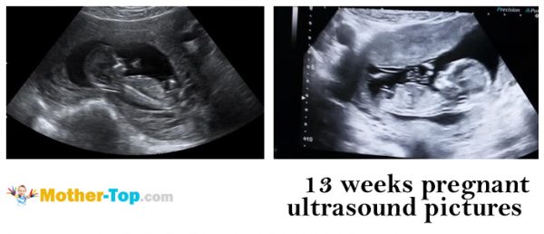 13 weeks pregnant ultrasound pictures