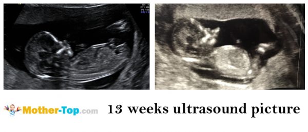 13 weeks ultrasound picture