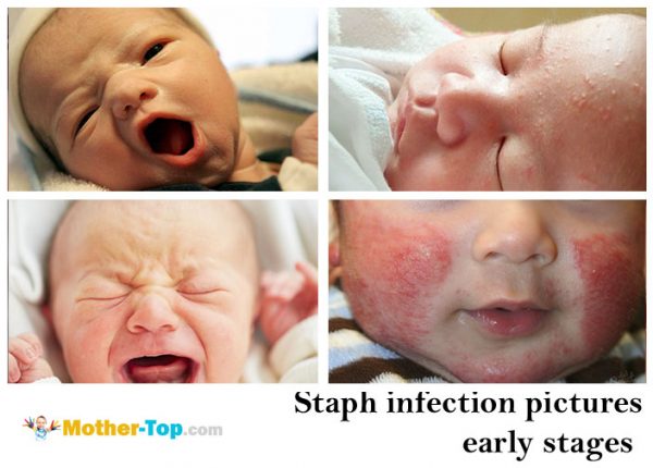 staph infection pictures early stages