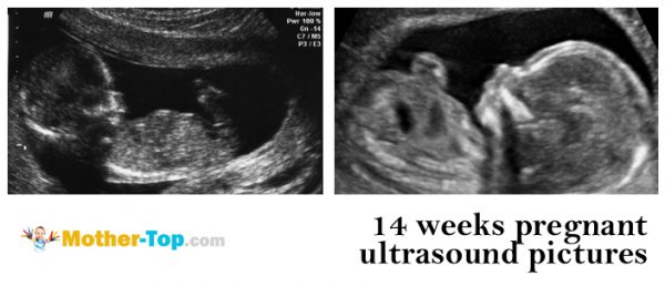 14 weeks pregnant ultrasound pictures