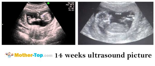 14 weeks ultrasound picture