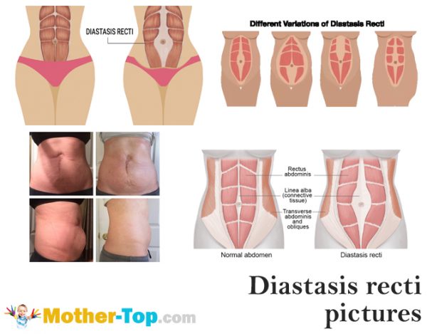 diastasis recti pictures