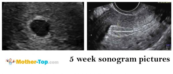 5 week sonogram pictures