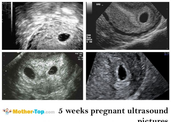 5 weeks pregnant ultrasound pictures
