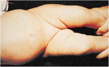 Asymmetric skin folds on hips