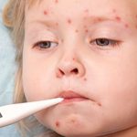 Chickenpox in children. Symptoms and treatment