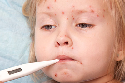 Chickenpox in children Symptoms and treatment