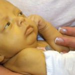 Physiologic jaundice in newborns