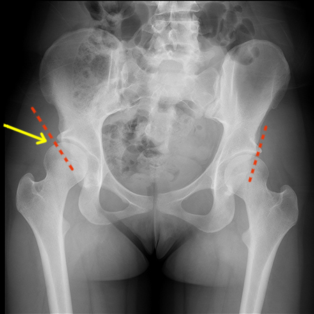 This is how hip dysplasia looks like.