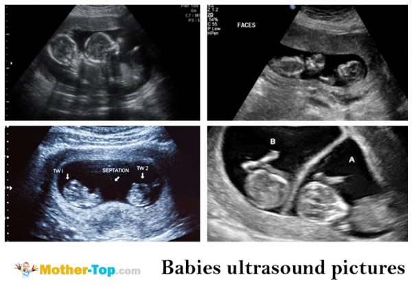 babies ultrasound pictures