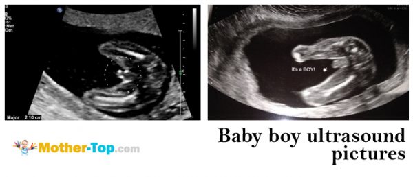 baby boy ultrasound pictures