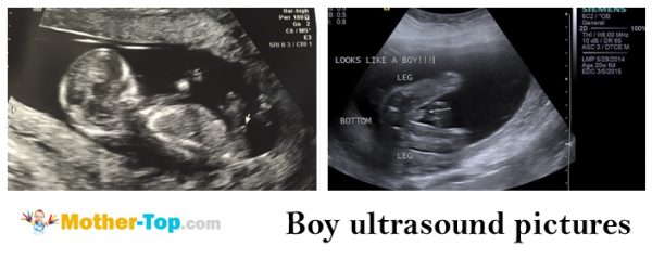 boy ultrasound pictures
