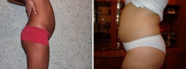 11 weeks pregnant Photos of the abdomen