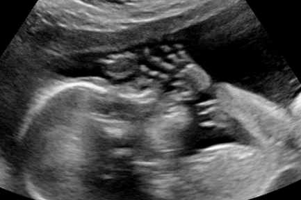 Ultrasound schedule during pregnancy