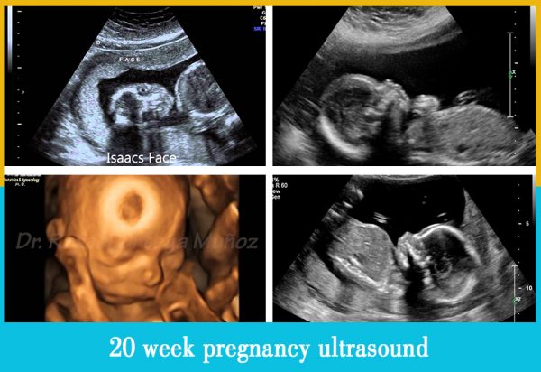 20 week pregnancy ultrasound