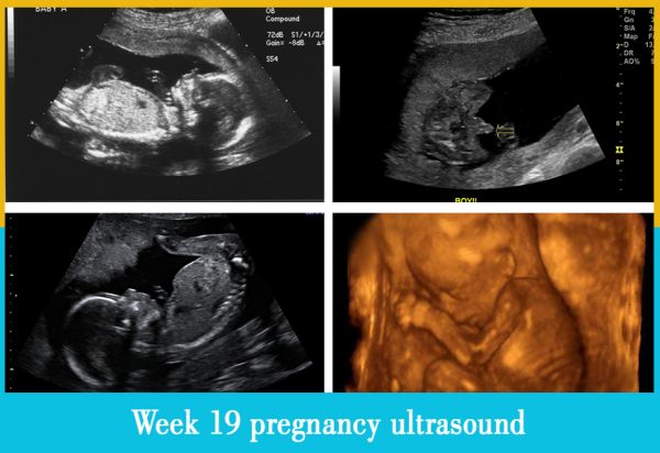 week 19 pregnancy ultrasound