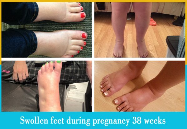 swollen feet during pregnancy 38 weeks