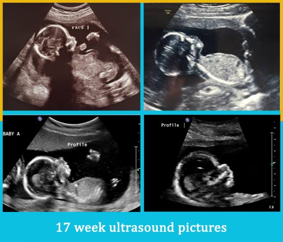17 week ultrasound pictures