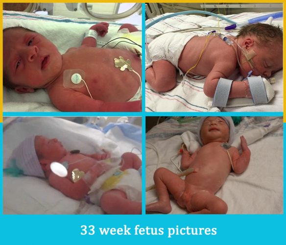 33 week fetus pictures
